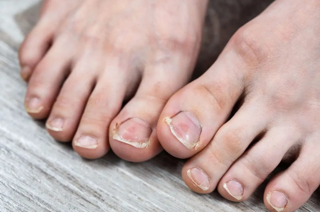 Ingrown Toenails: Prevention Tips for Healthy Feet