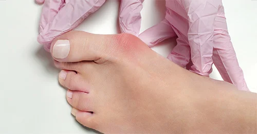 Understanding Bunion Surgery: Is It the Right Option for You?