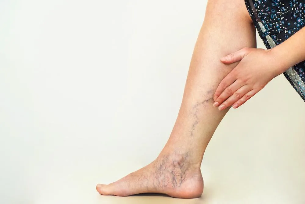 How Pregnancy Can Contribute to Varicose Veins