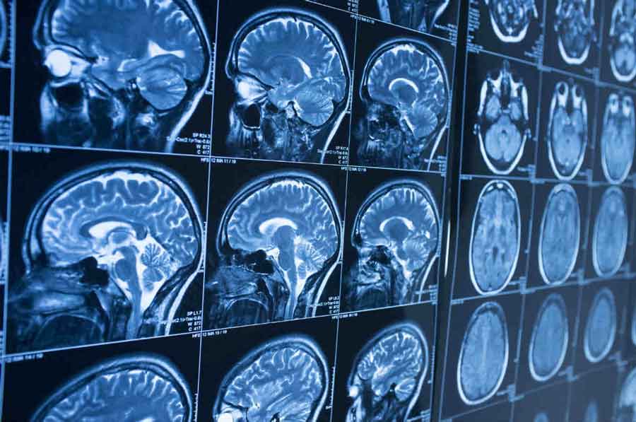Reasons To Schedule a Brain Surgery Consultation
