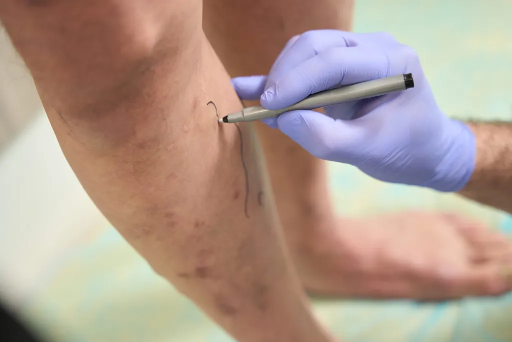 Understanding Varicose Veins and Their Connection to Circulatory Health