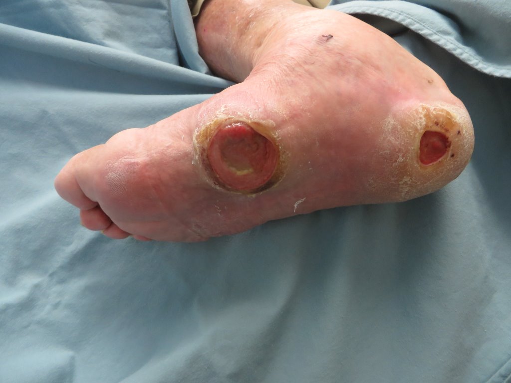What To Expect From Diabetic Wound Care Programs