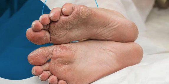 Why Diabetic Foot Care Should Be Managed by a Healthcare Professional