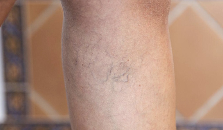 Identifying Early Signs of Vascular Insufficiency